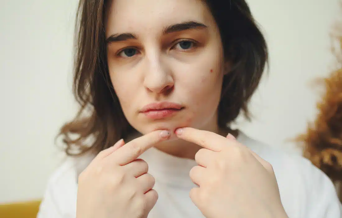 Акне по брадичката: всичко, което всяка жена трябва да знае