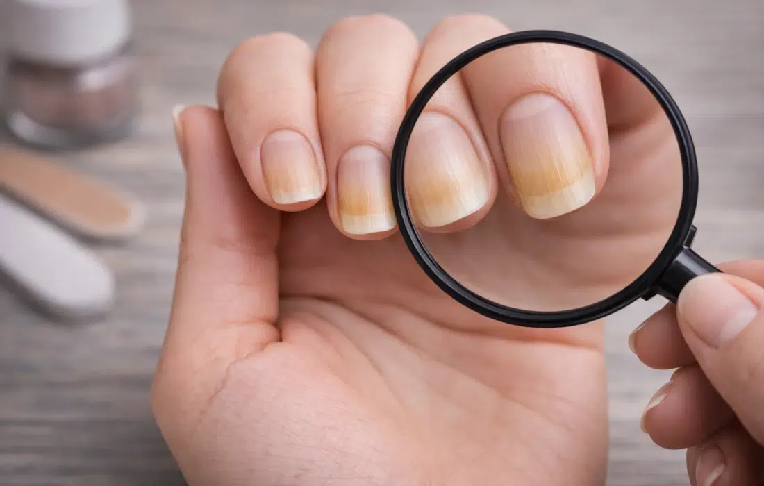 Пожълтели нокти? Ето 4 възможни причини!
