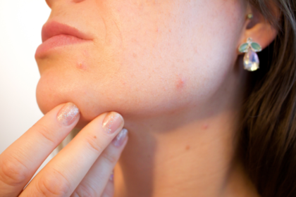 Акне по брадичката: всичко, което всяка жена трябва да знае