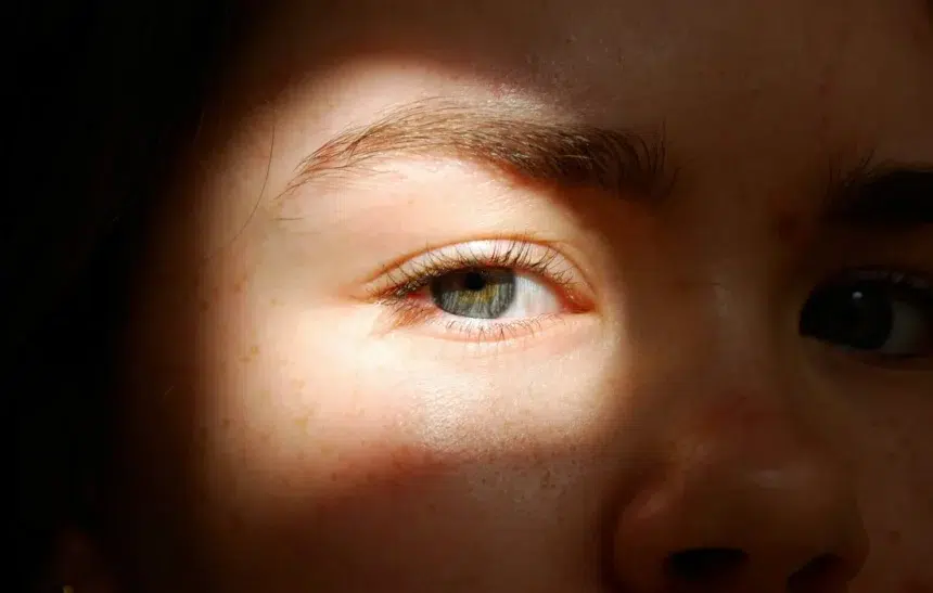 Как да се справите с мелазмата?